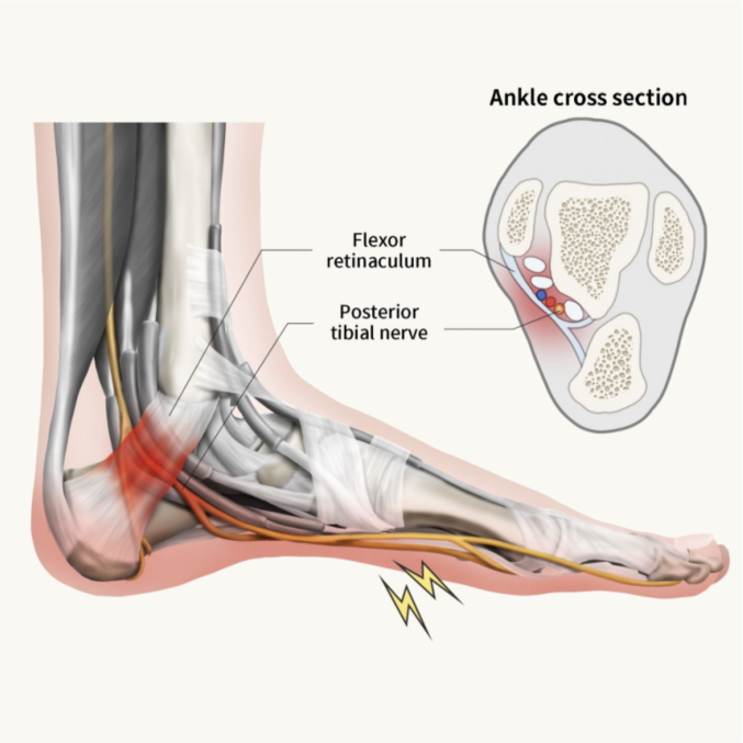 발바닥이 화끈하고 저리다면?